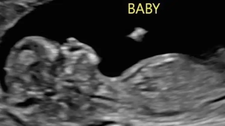 Pregnant WWE Star Becky Lynch Shares First Ultrasound Photo